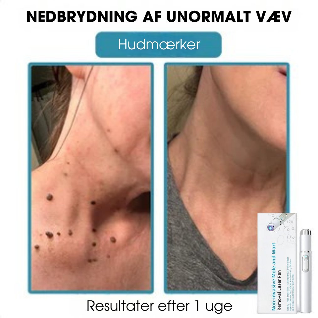 DermaLight Pro™ - Ikke-invasiv laserpen til modermærker, vorter og hudflapper