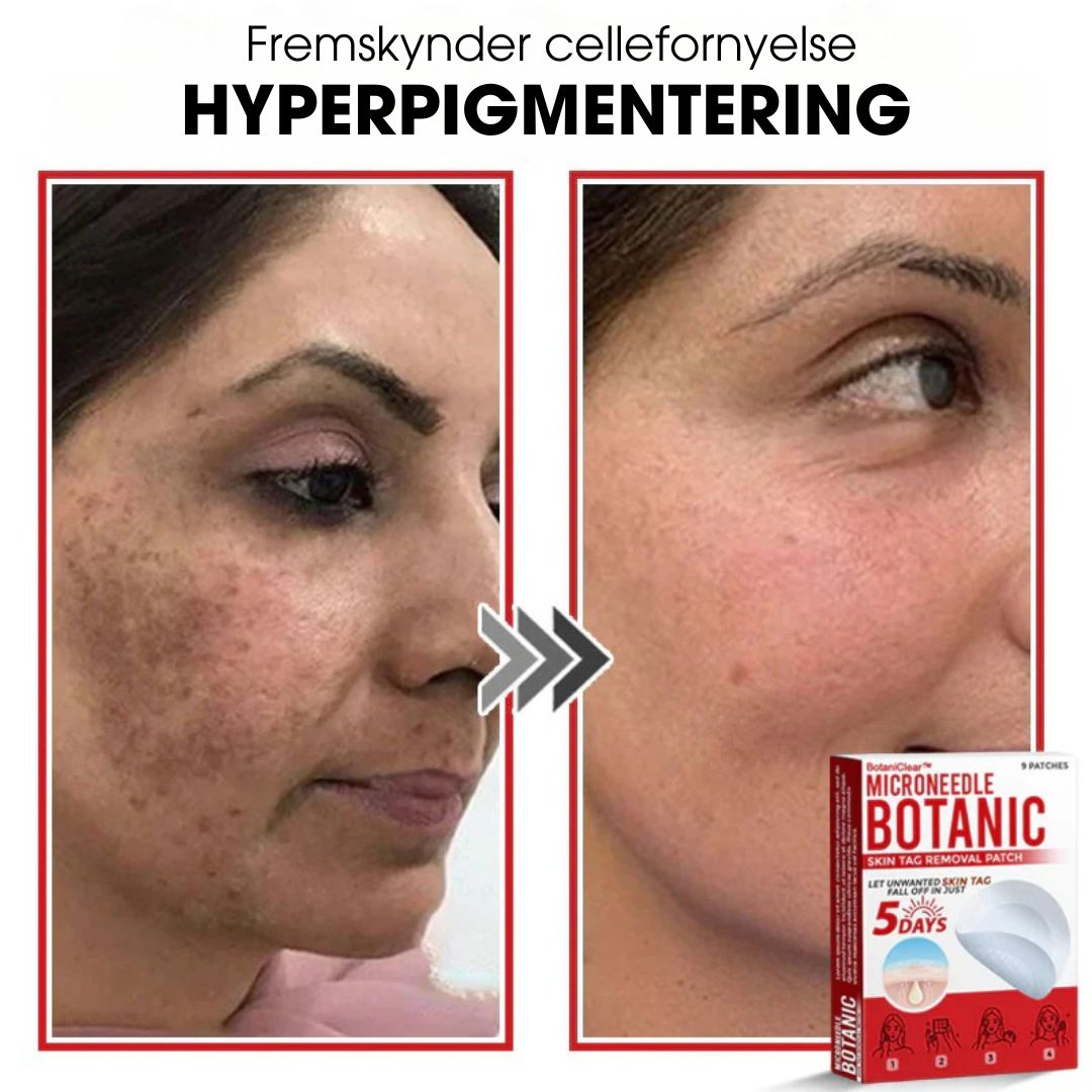 BotaniClear™ – Microneedle-patch til hudflapper - 1+1 GRATIS