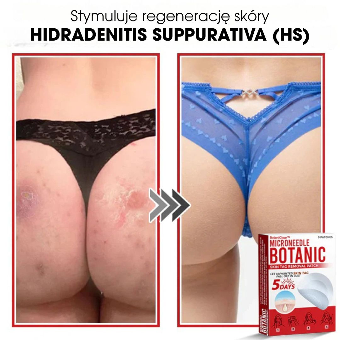 BotaniClear™ – Microneedle-patch til hudflapper - 1+1 GRATIS