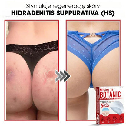 BotaniClear™ – Microneedle-patch til hudflapper - 1+1 GRATIS