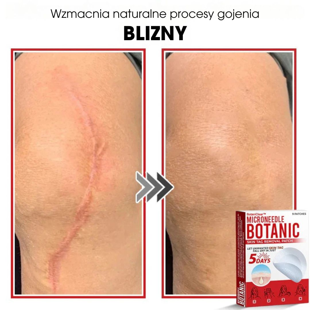 BotaniClear™ – Microneedle-patch til hudflapper - 1+1 GRATIS