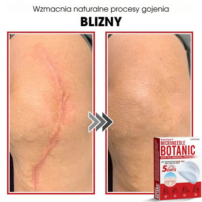 BotaniClear™ – Microneedle-patch til hudflapper - 1+1 GRATIS