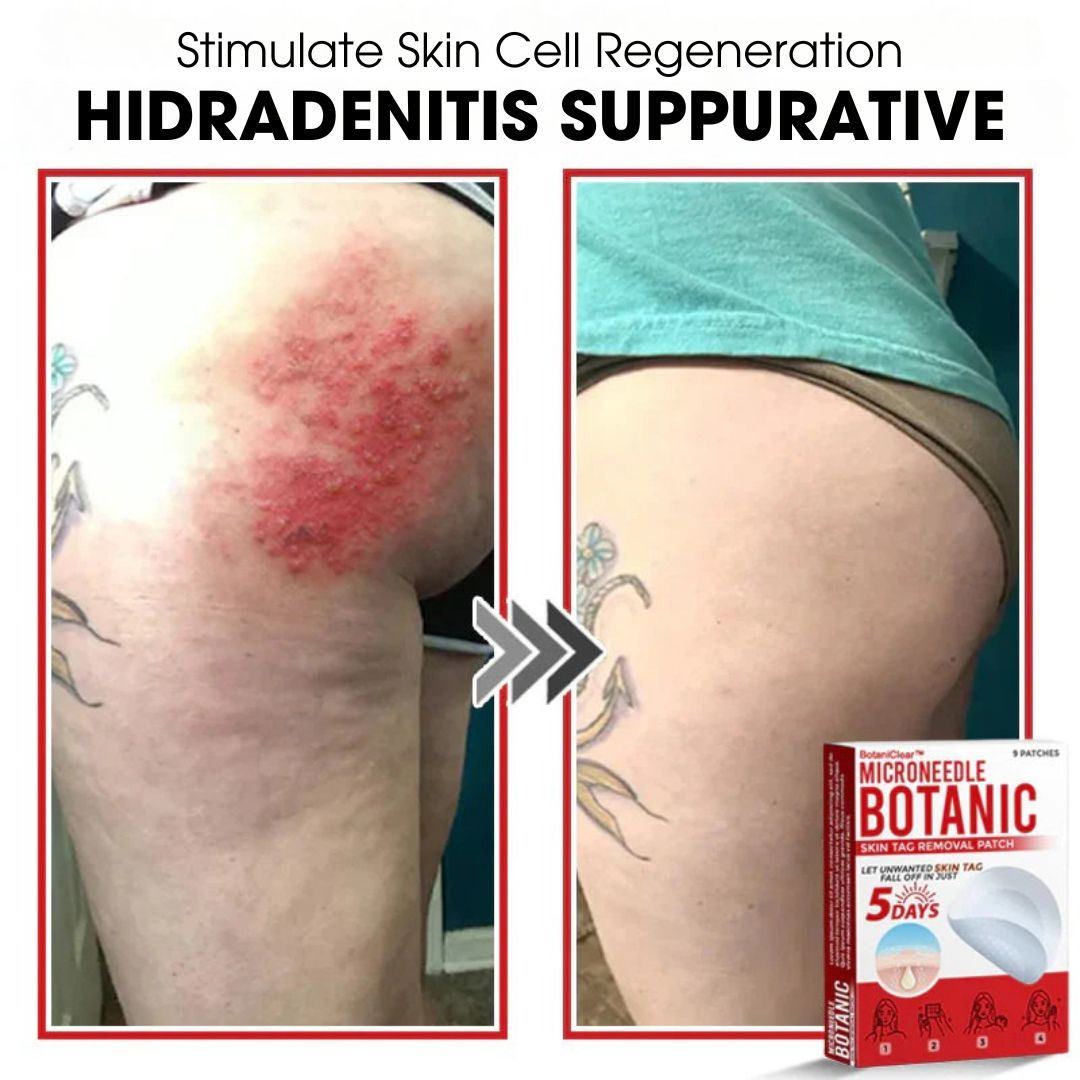 BotaniClear™ – Microneedle-patch til hudflapper - 1+1 GRATIS