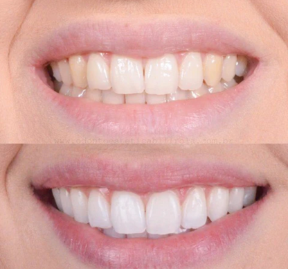 BrightSmile™ – Klinik-inspireret tandblegning til hjemmebrug