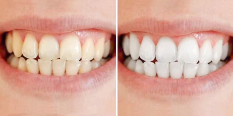 BrightSmile™ – Klinik-inspireret tandblegning til hjemmebrug