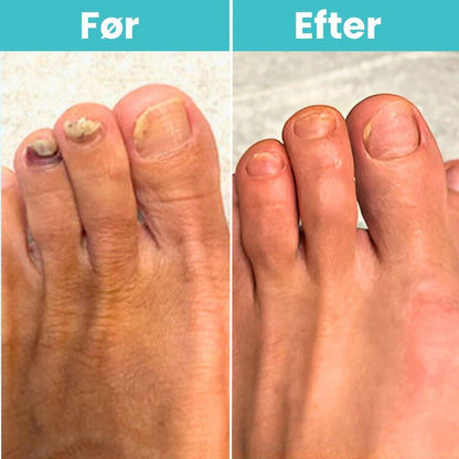 FungiClear Pro™ – Laserbehandling der bekæmper svamp ved roden