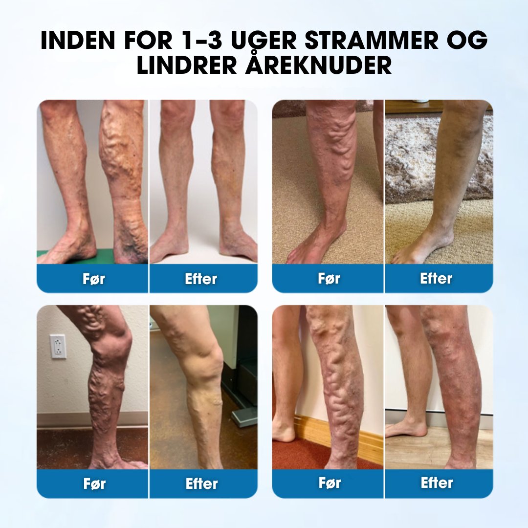 Timilk® VeinGuard – Klinisk bevist til at reducere åreknuder