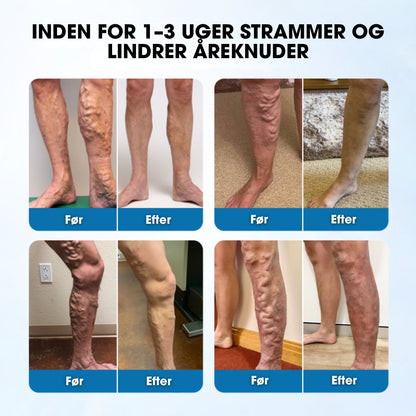 Timilk® VeinGuard – Klinisk bevist til at reducere åreknuder