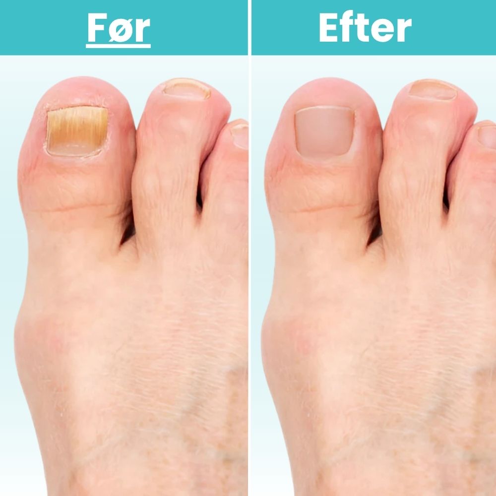 FungiClear Pro™ – Laserbehandling der bekæmper svamp ved roden