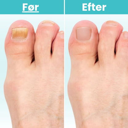 FungiClear Pro™ – Laserbehandling der bekæmper svamp ved roden