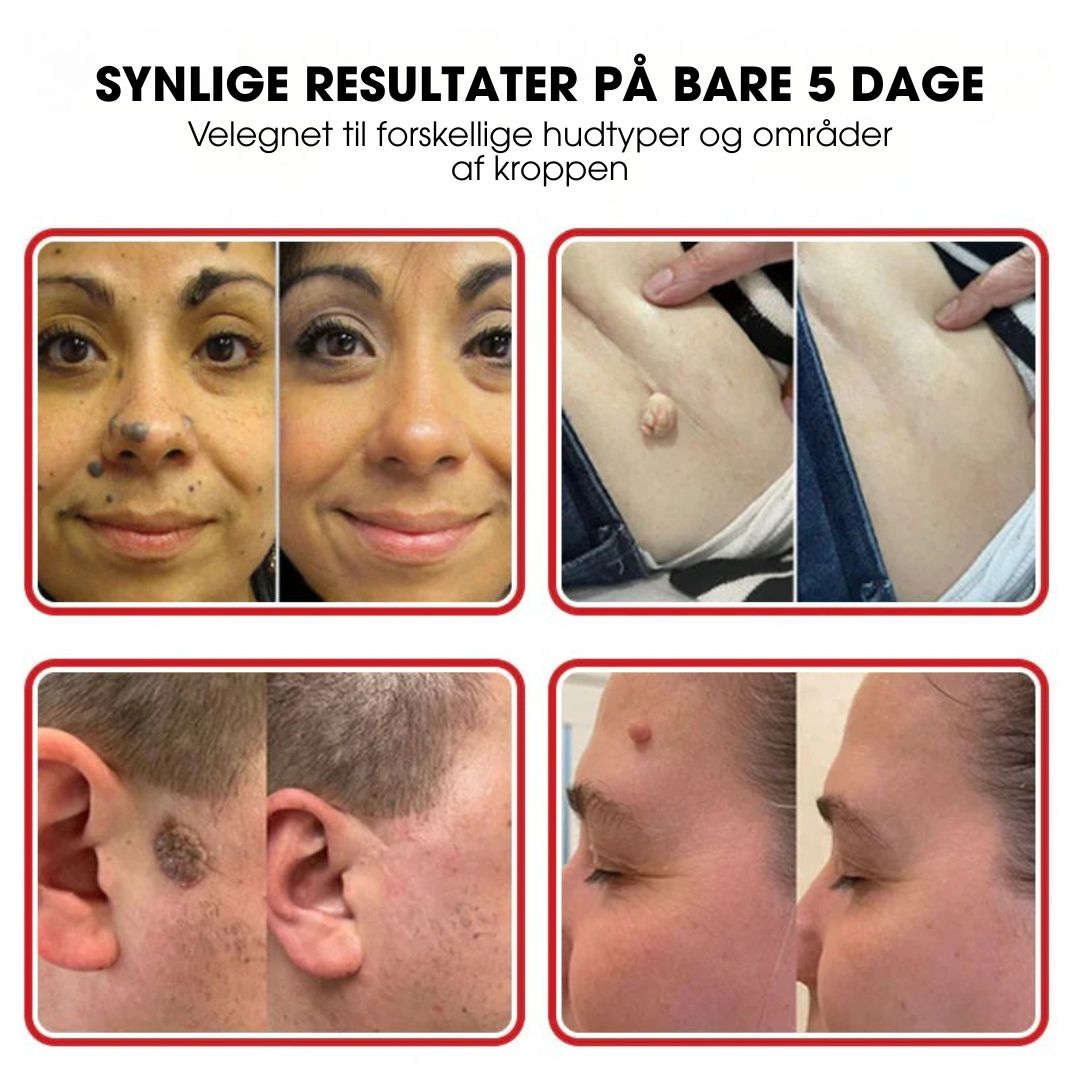 BotaniClear™ – Microneedle-patch til hudflapper - 1+1 GRATIS