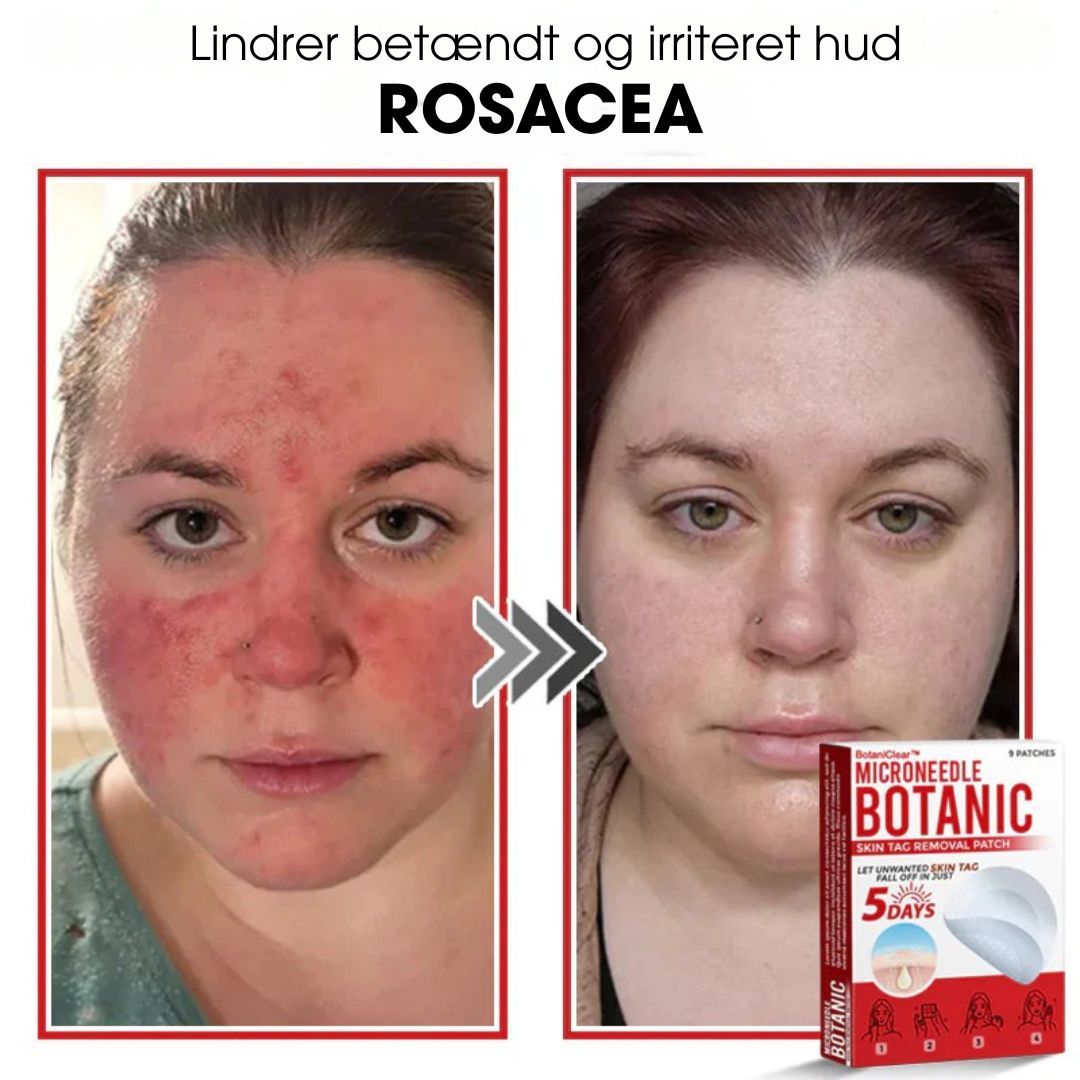 BotaniClear™ – Microneedle-patch til hudflapper - 1+1 GRATIS